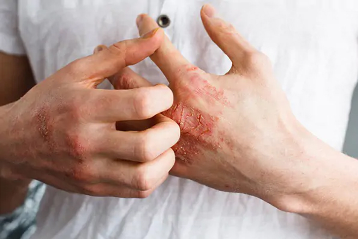 Bệnh lây qua đường tình dục là gì? Dấu hiệu nhận biết và cách phòng tránh hiệu quả Bệnh lây qua đường tình dục là gì? Dấu hiệu nhận biết và cách phòng tránh hiệu quả